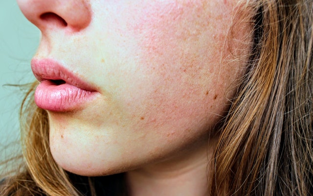 פרצוף של אישה עם גירוי בעור